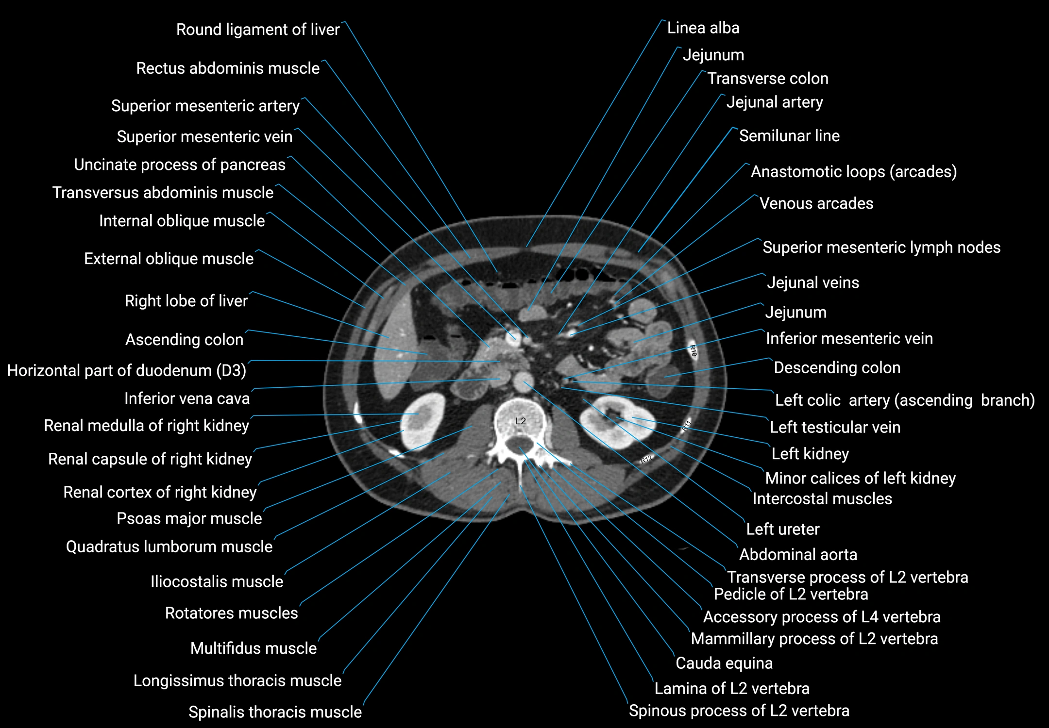 CT male pelvis axial cross sectional anatomy labelled radiology image -00075.webp